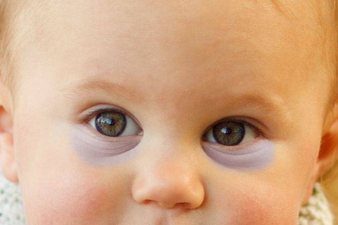 Почему у ребенка голубые глаза. Синяки под глазами у грудничка. Мешки под глазами у ребенка. Припухлость под глазами у ребенка. Синие круги под глазами у ребенка.