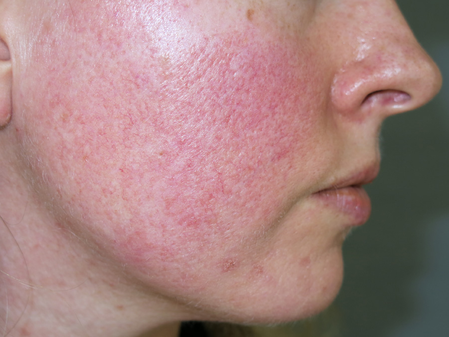 Себорея. acne vulgaris