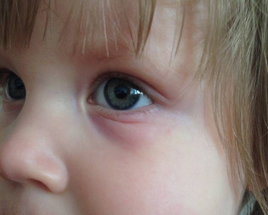 Воспалительные заболевания глаз у детей