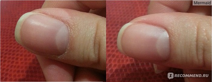 Почему сохнет кожа на руках вокруг ногтей: как лечить
