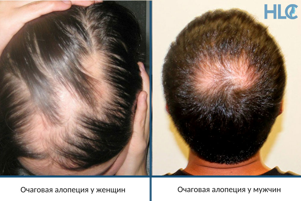 Плазмолифтинг головы для волос: что это, преимущества и недостатки