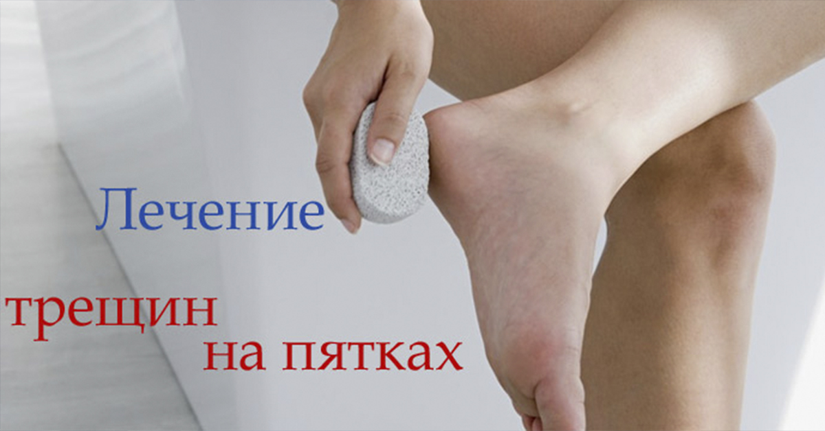 18 домашних способов лечения трещин и огрубевшей кожи стоп | безполитики.ру