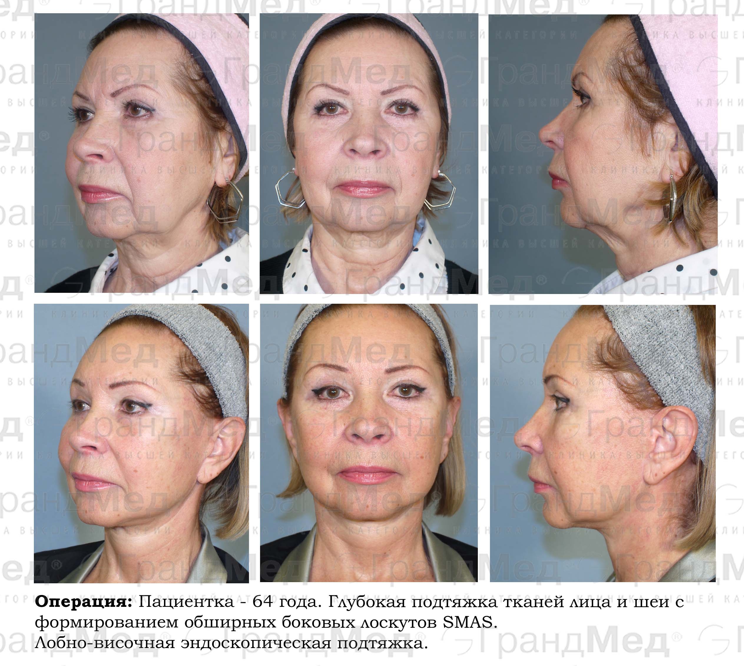 Плазмолифтинг отзывы фото до и после лицо. Плазмолифтинг (плазмотерапия). Плазмолифтинг для лица. Плазмолифтинг лица до и после. Плазменный лифтинг лица.