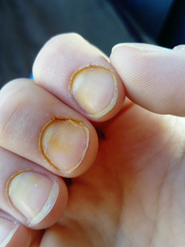 Почему желтеют ногти на руках - основные причины