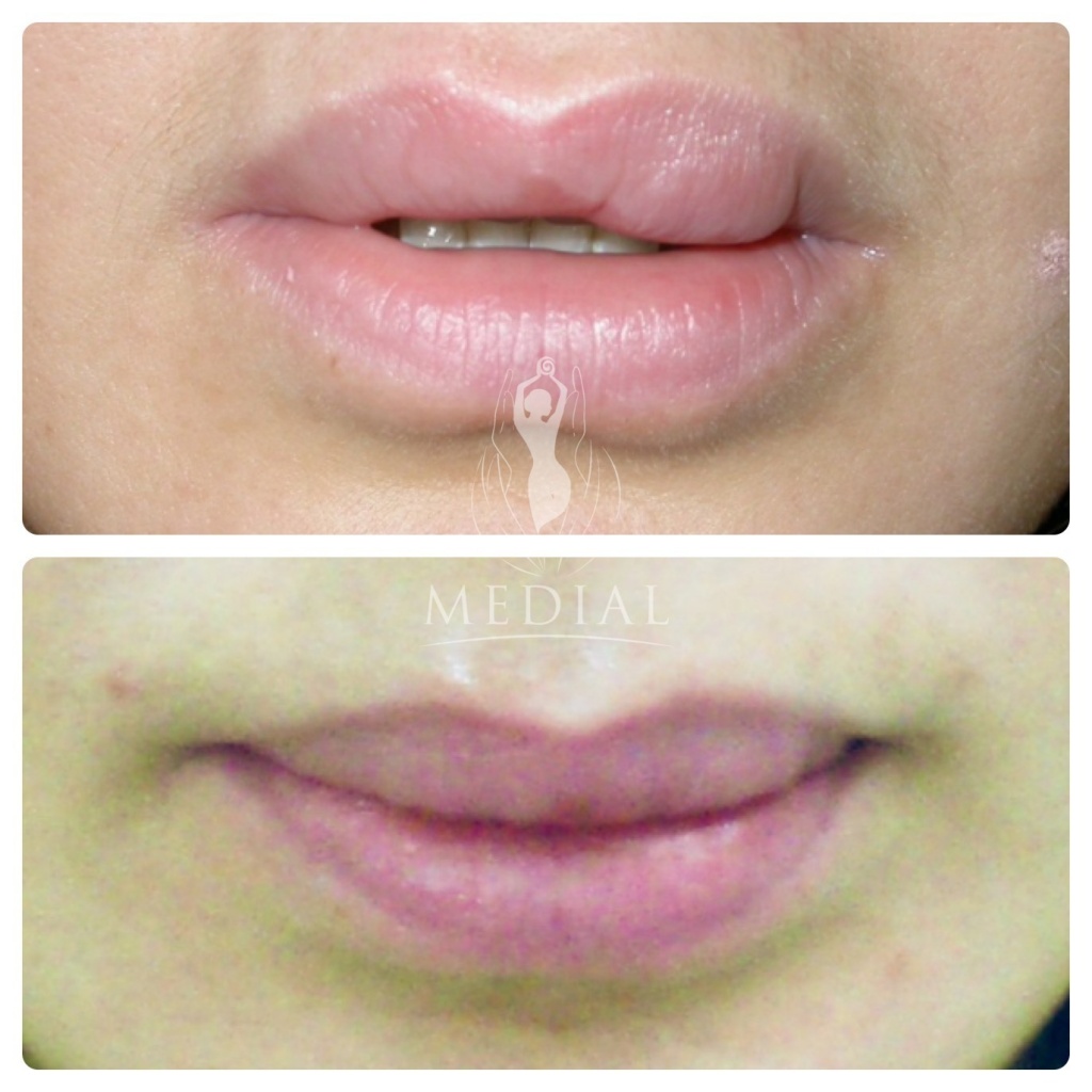 Пластика губ (хейлопластика) | пластический хирург орландо салас