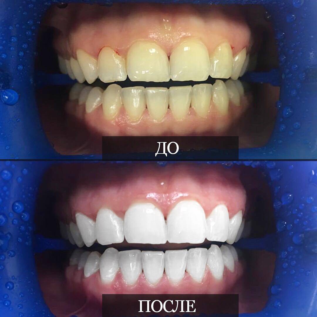 Отбеливание зубов до и после