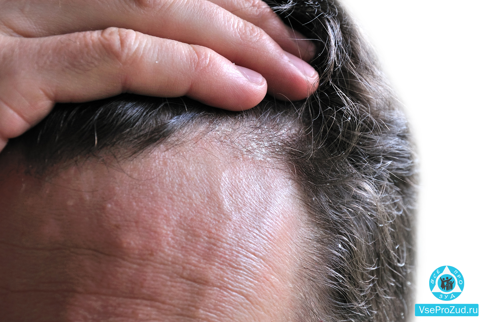 Как лечить экзему на коже головы 
 | клиника меди лайф