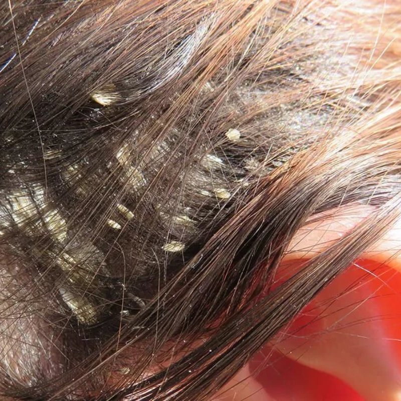 Лечение себореи волосистой части головы – публикации – лаборатория ан-тек