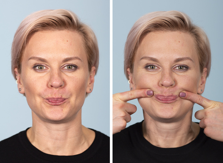 Процедура увеличения губ от выбора техники до результата. фото