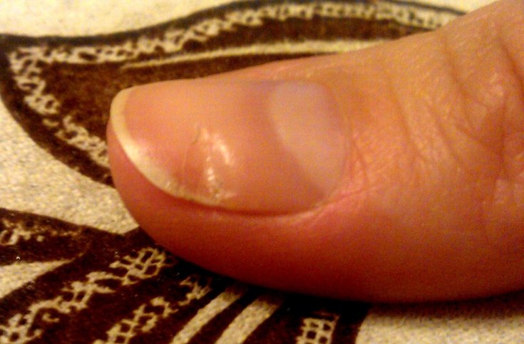 Ногти стали бугристые причины. волнистые ногти на руках: как лечить в домашних условиях | маникюр