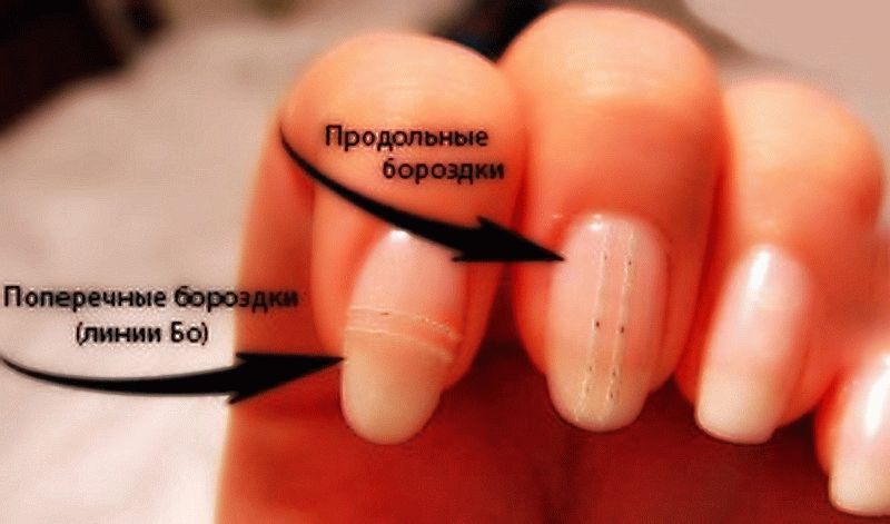 Причины для полос на ногтях рук продольных и вертикальных, и что это значит, почему появляются, как устранить?