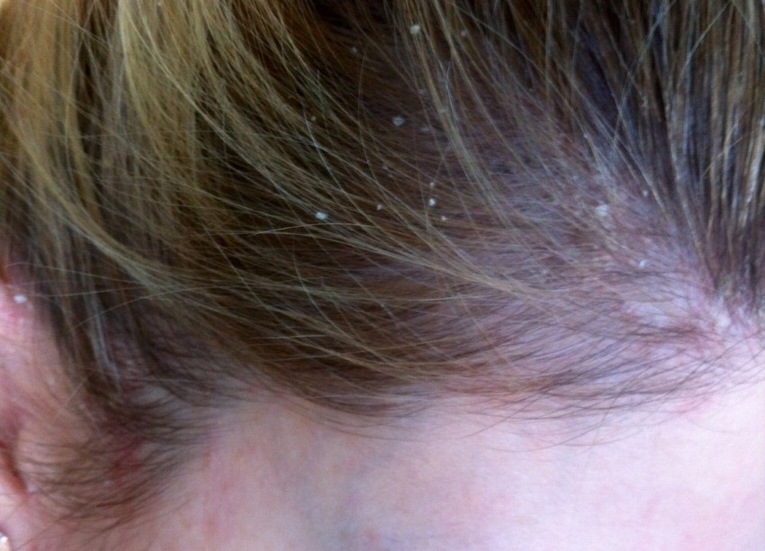 Псориаз на голове. псориаз волосистой части головы: лечение, симптомы и причины :: syl.ru