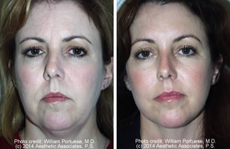 Миостимуляция лица: результативный метод улучшения внешности