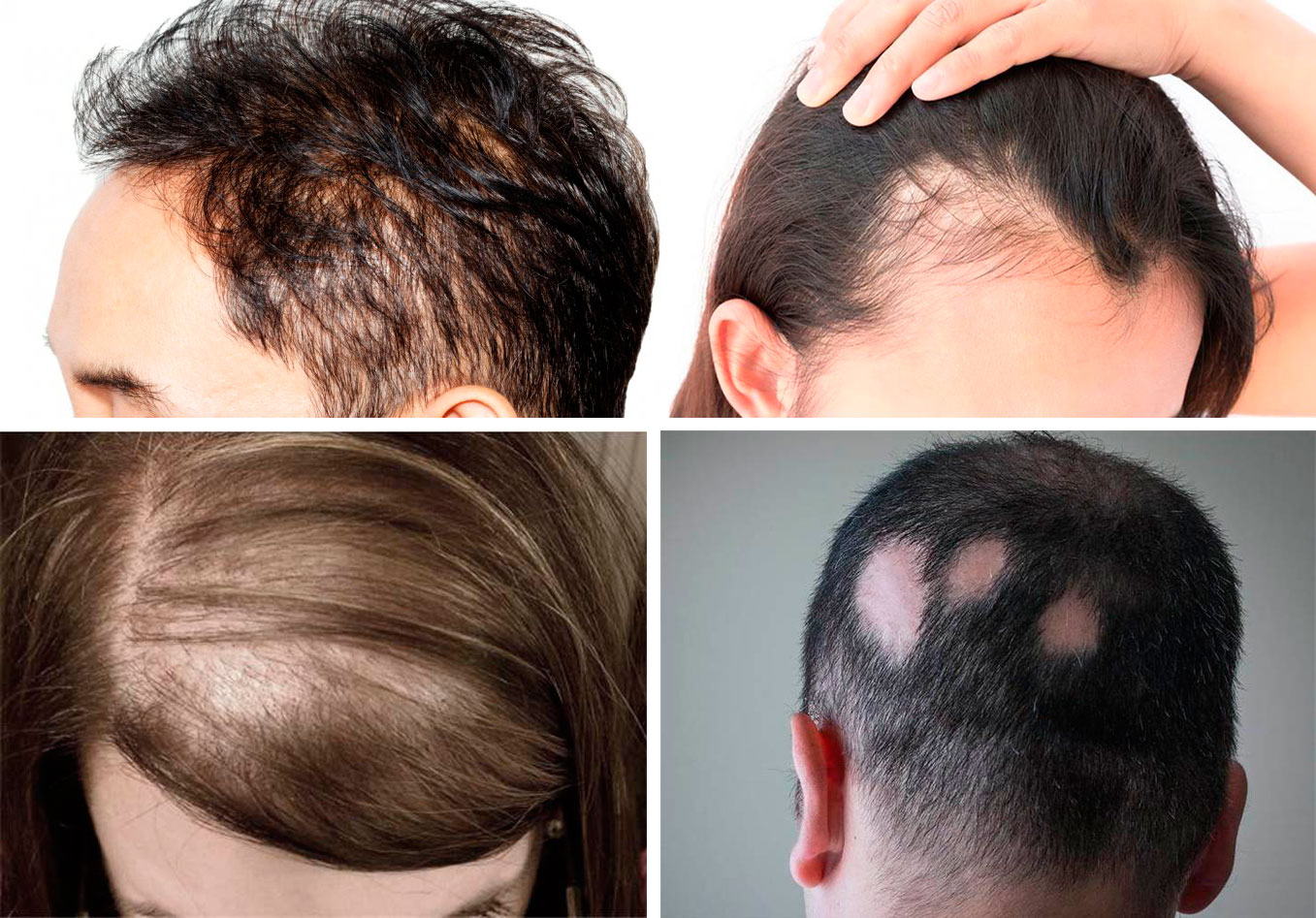 Алопеция: как сохранить свои волосы