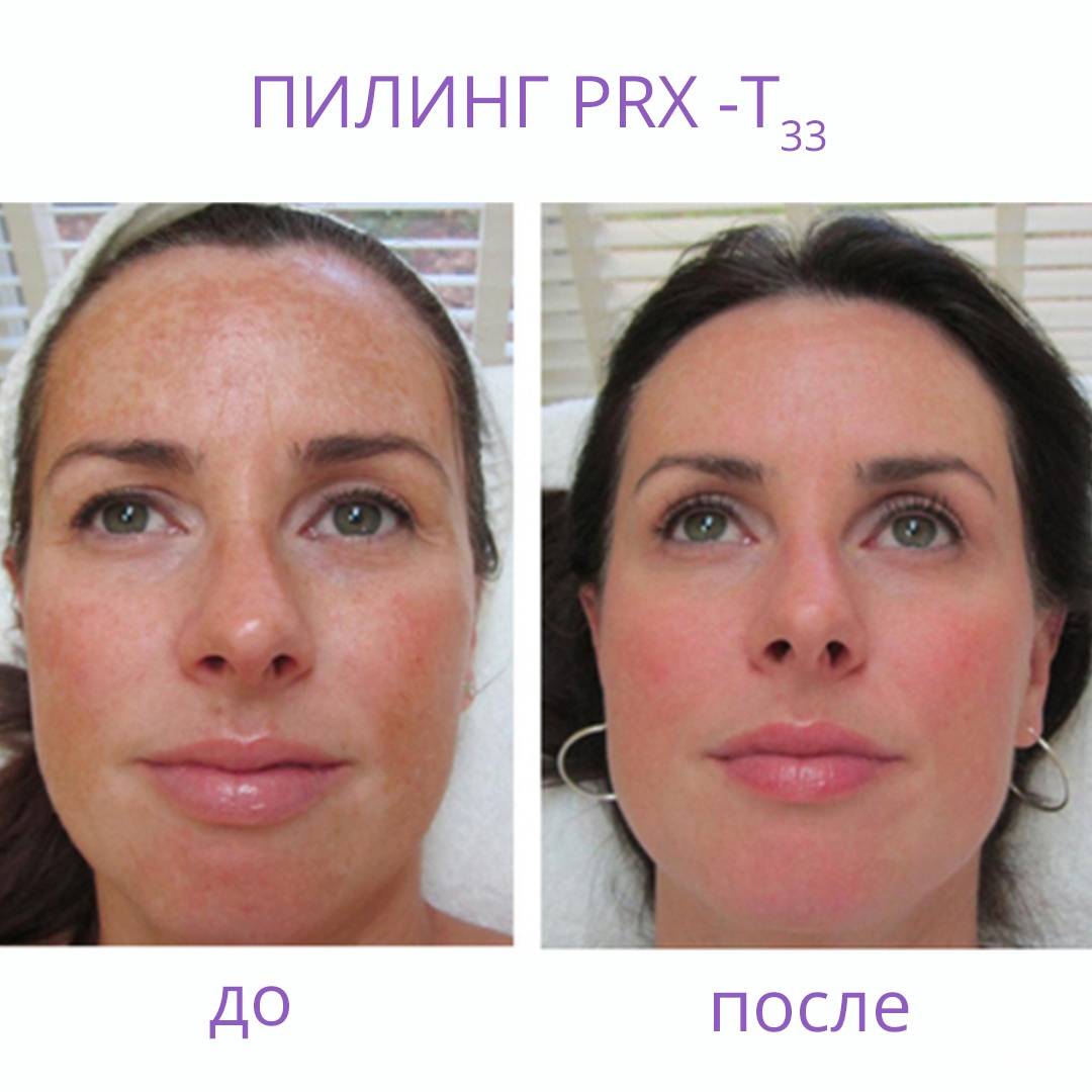 Химический пилинг кожи лица и тела