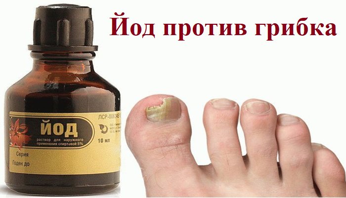 Как лечить грибок ногтей на ногах йодом - народные способы лечения