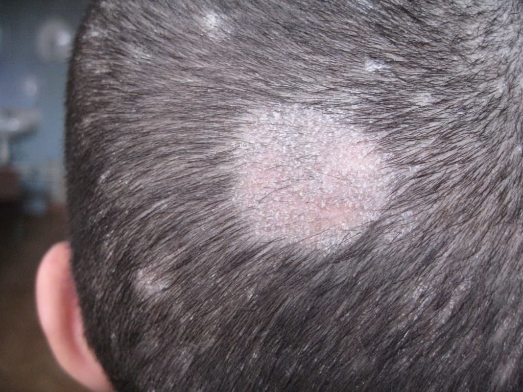 Псориаз на голове:средства для лечения кожи в домашних условиях