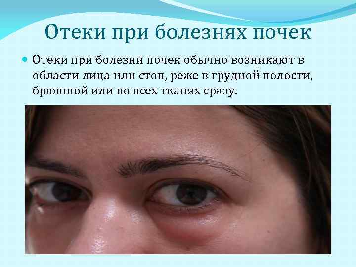 Кровоизлияние в глаз: как долго проходит, капли при кровоизлиянии