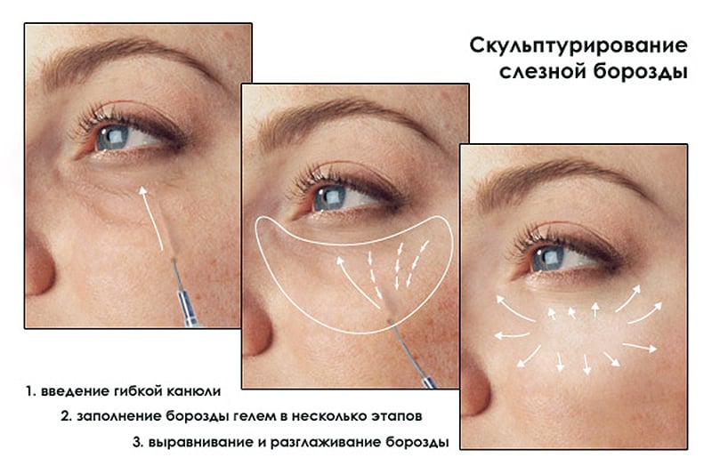 Схема коррекции лица филлерами