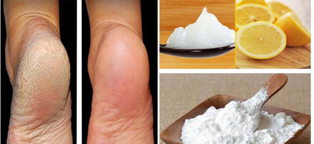 18 домашних способов лечения трещин и огрубевшей кожи стоп