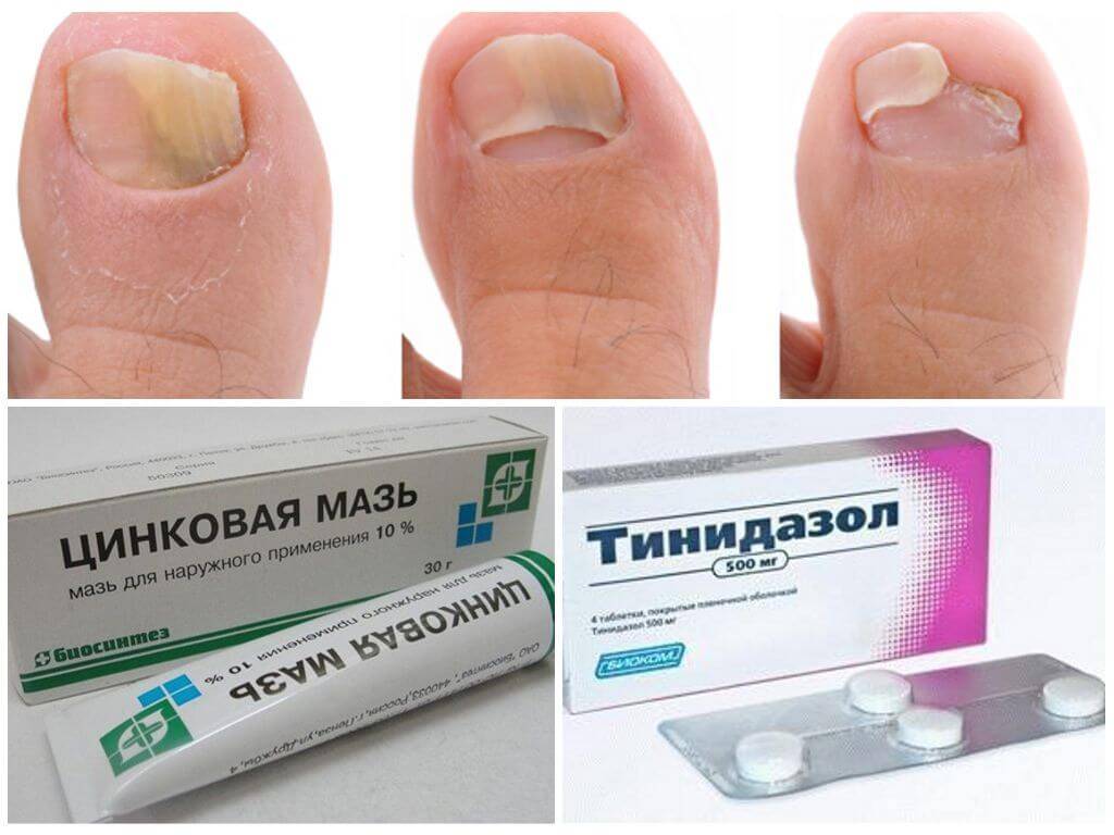 Противогрибковые препараты для ногтей: обзор средств и методов лечения. 105 фото и видео советы по профилактике грибковых заболеваний
