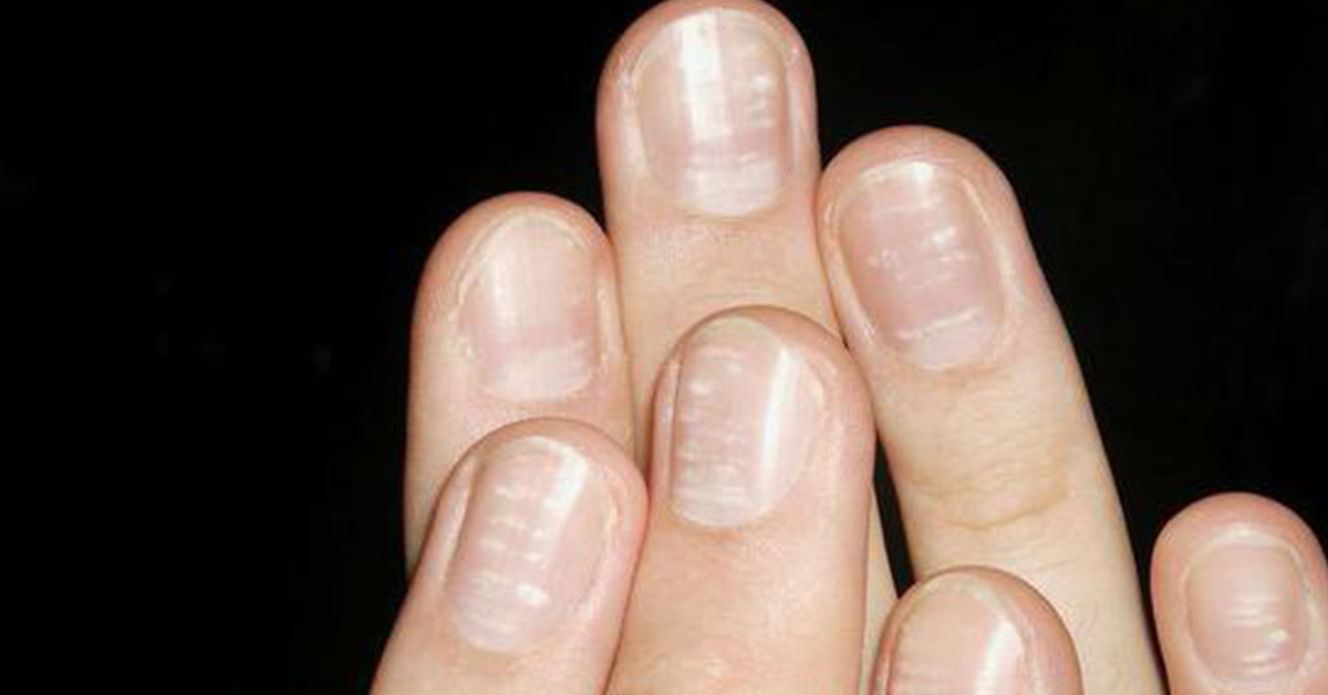 Волнистые ногти на руках причины и лечение