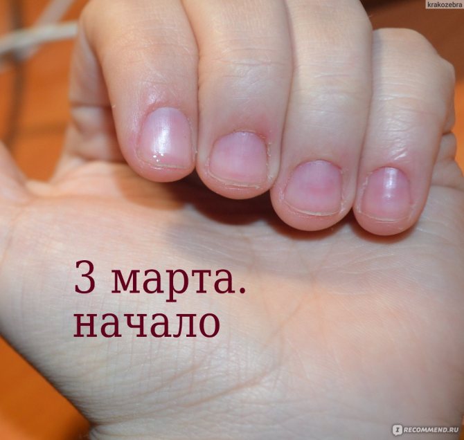 Как ускорить рост ногтей на руках в домашних условиях
как ускорить рост ногтей на руках — modnayadama