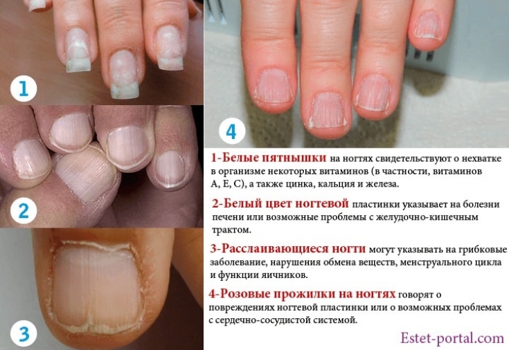 Что означают продольные и поперечные полосы на ногтях рук? причины и лечение