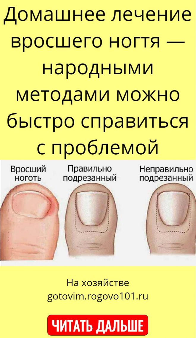 Как правильно подрезать ногти? центр подологии и ногтевой эстетики