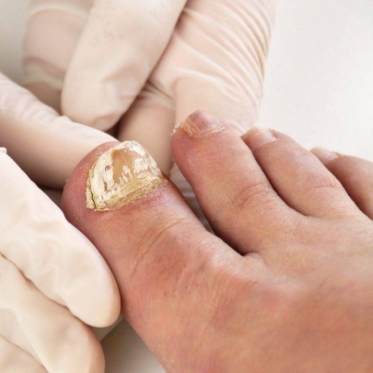 Современные способы удаления ногтя на ноге при грибке