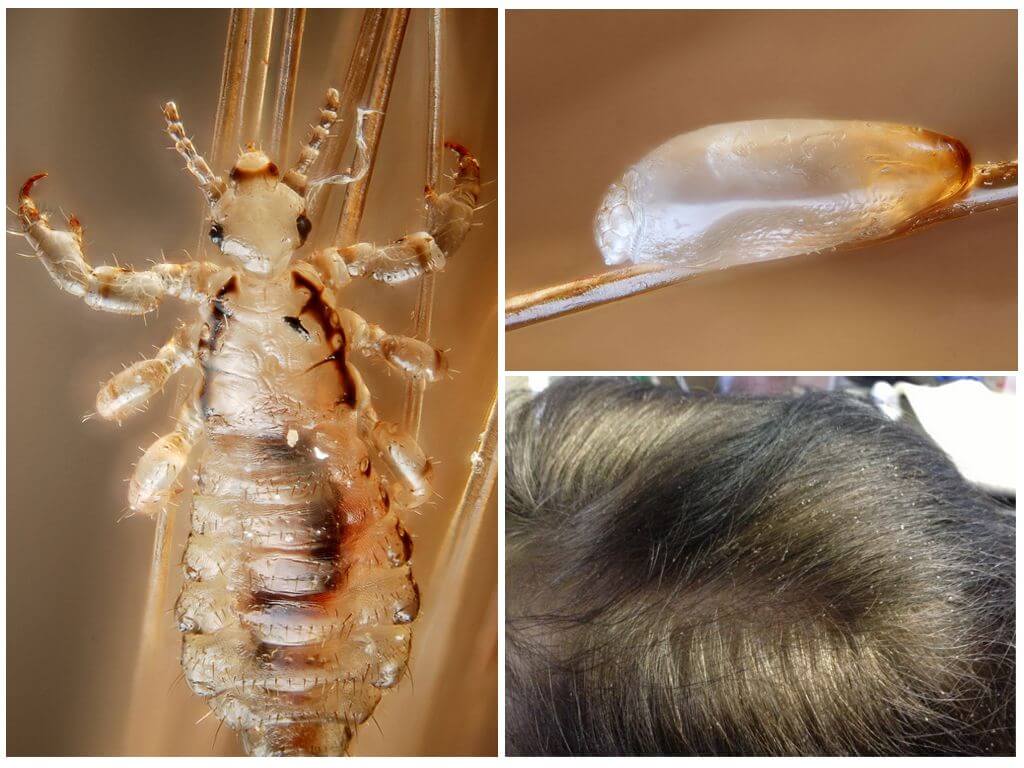 Какие бывают вши: разновидности паразитов на голове и на теле у человека, чем опасны