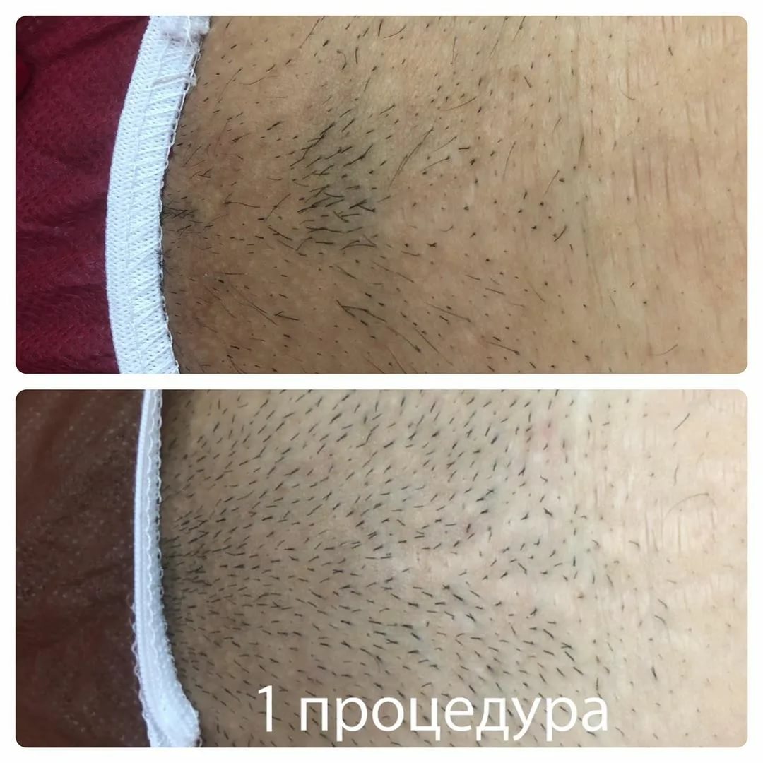 Лазерная эпиляция помогает в некоторой степени омолодить кожу - косметология доктора корчагиной
