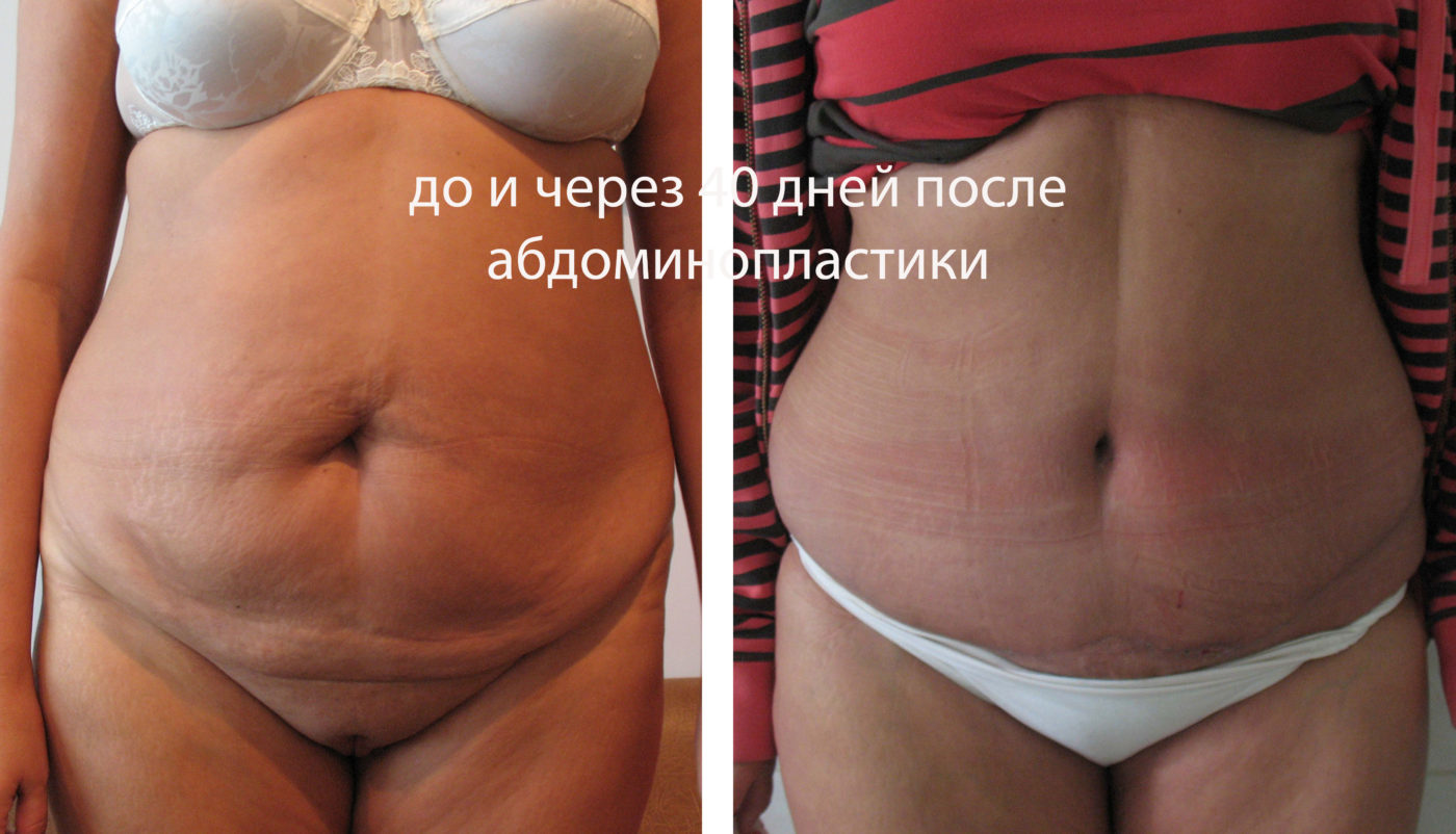 Абдоминопластика: 43 фото до и после коррекции формы живота