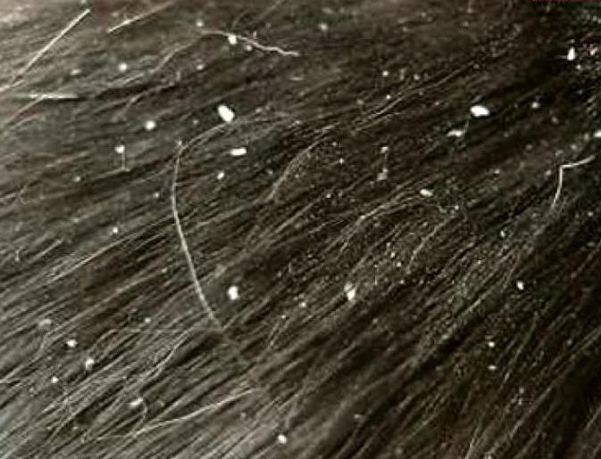 Как отличить перхоть от гнид на волосах — волосы