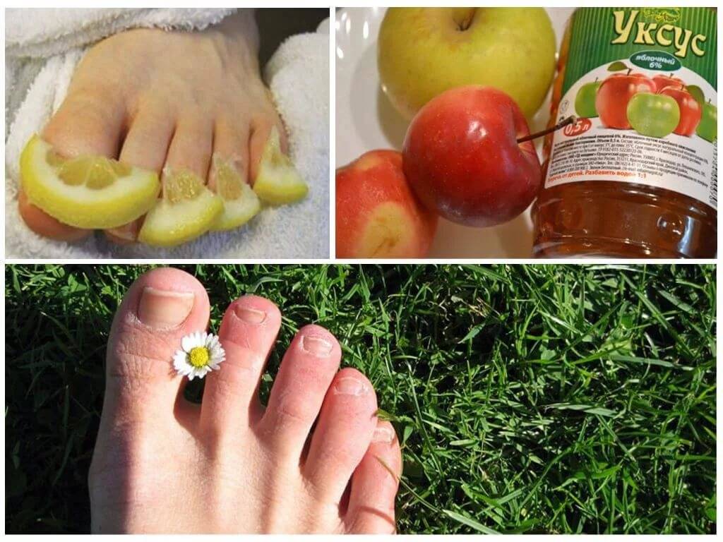 Как быстро вылечить грибок ногтей на ногах в домашних условиях