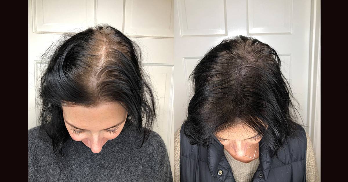 Алопеция у женщин: лечение женского облысения волос, причины и симптомы потери волос | регейн®