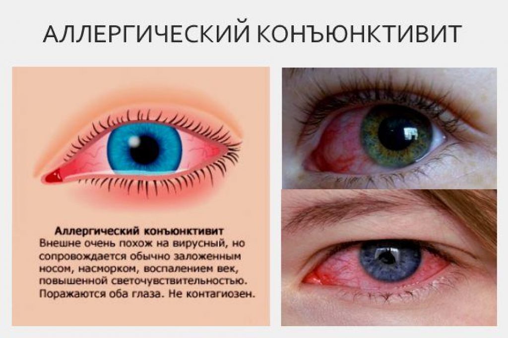 Синдром «красного глаза» — сага-оптика