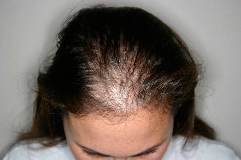 Диффузное выпадение волос: что это такое? причины, симптомы, лечение и отзывы - luv.ru