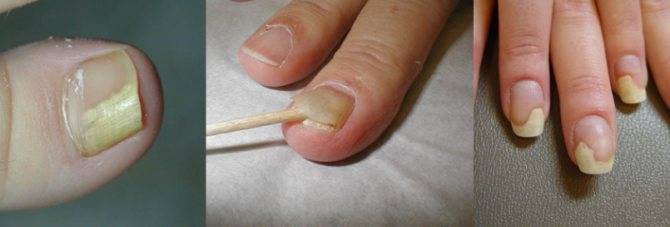 Лечение отслоения ногтевой пластины - подробное описание
