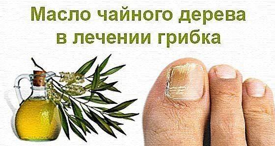 Лечение грибка ногтей маслом чайного дерева