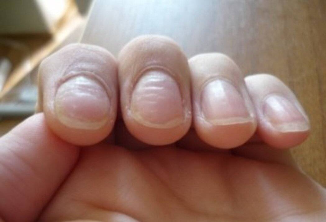 Почему ногти на руках становятся ребристыми