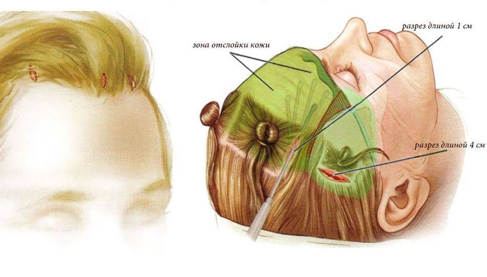 Эндоскопическая подтяжка бровей и лба с помощью устройства endotine forehead