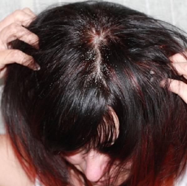Почему болит кожа головы у корней волос и что делать?