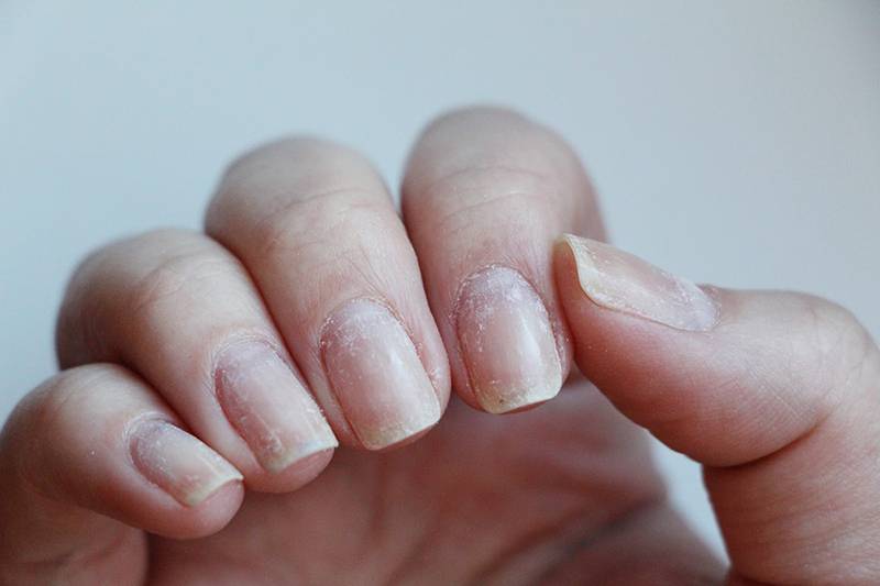 Как восстановить ногти после наращивания: способы