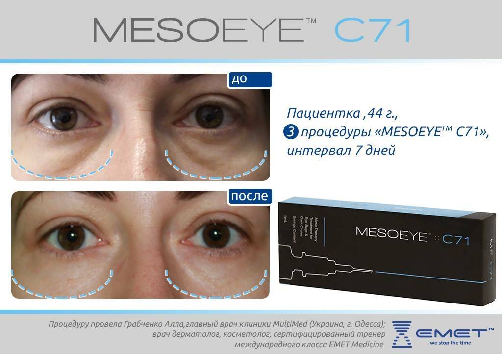 Мезоай (mesoeye с71)-биорепарант для кожи вокруг глаз | пластическая хирургия и косметология