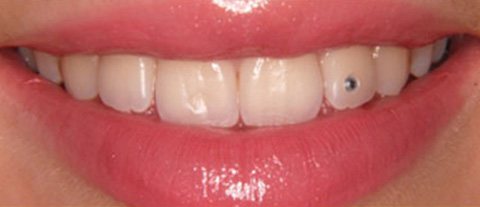 Скайсы: украшение зубов, плюсы и минусы, правильный уход