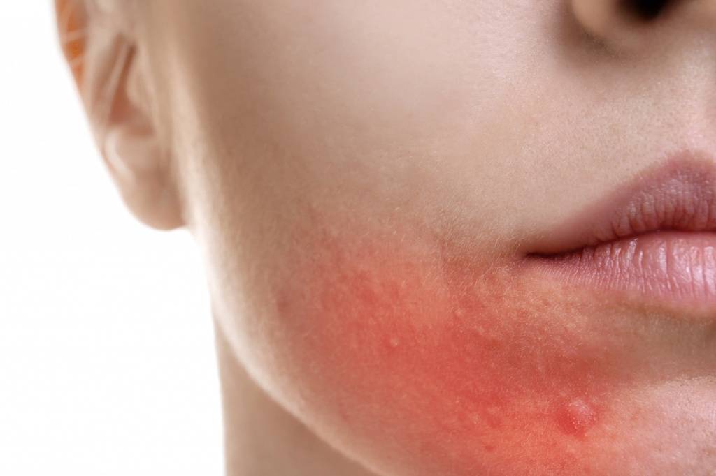Полезная информация: что такое кожный дерматит, и как его лечить?