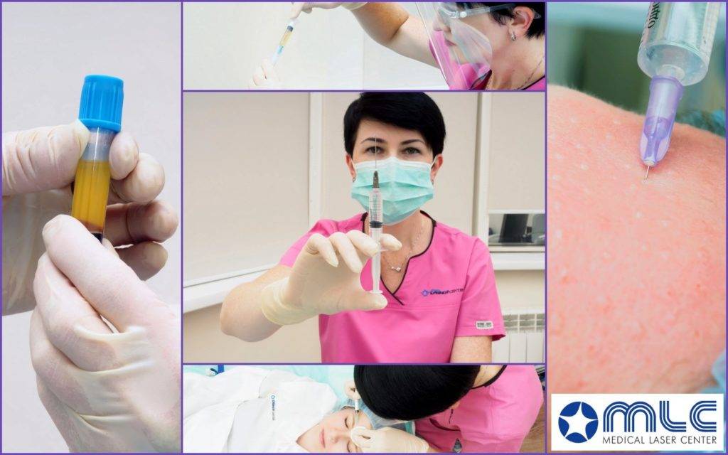 Плазмолифтинг: инъекции аутоплазмы в проблемные зоны кожи