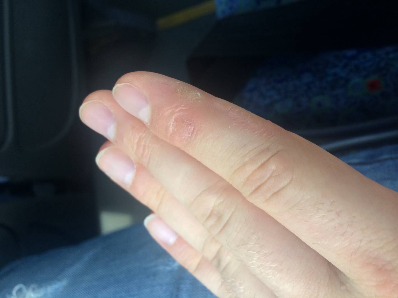 Сухая кожа рук: почему шелушатся и сохнут ладони и пальцы, что делать с сухостью и чем увлажнять