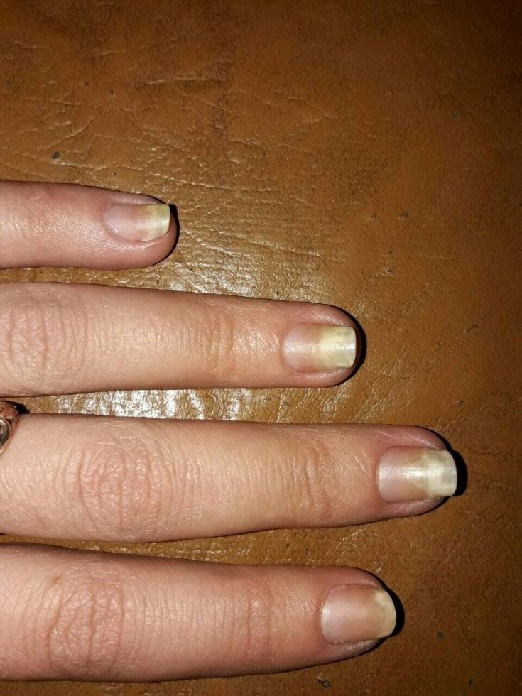 Причины, почему ногти на руках стали ребристыми